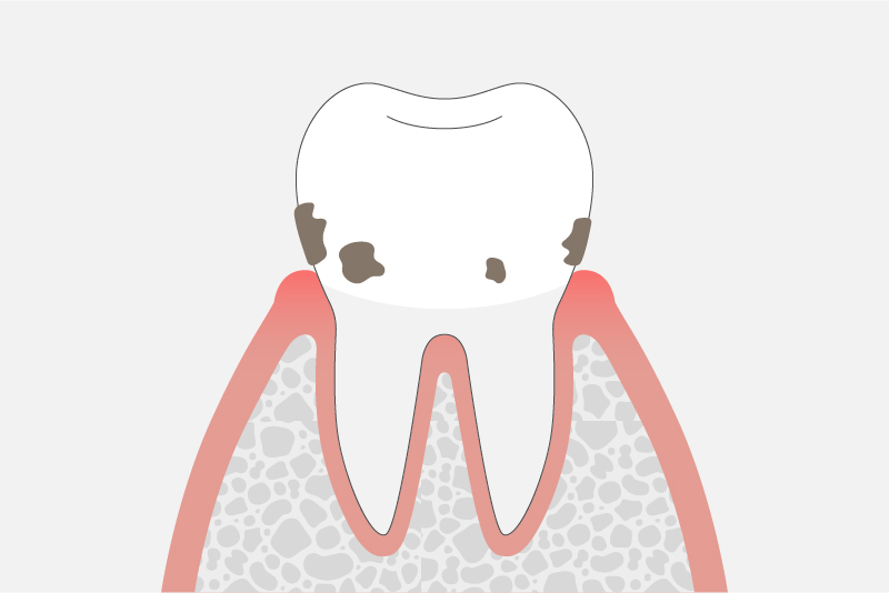 軽度歯周炎