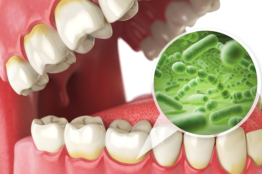 歯周病になる原因とは