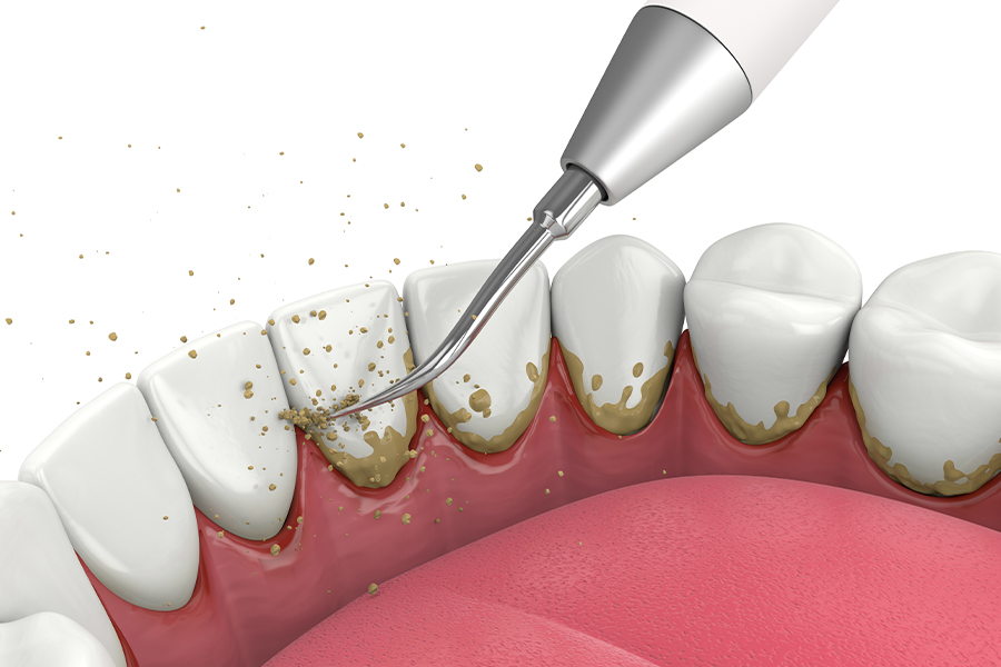 プラーク・歯石の除去