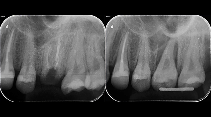 04 歯の移植（自家歯牙移植）