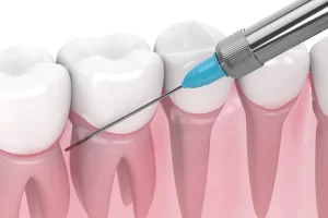 歯周病の外科的治療